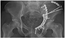 Pelviacetabular Trauma